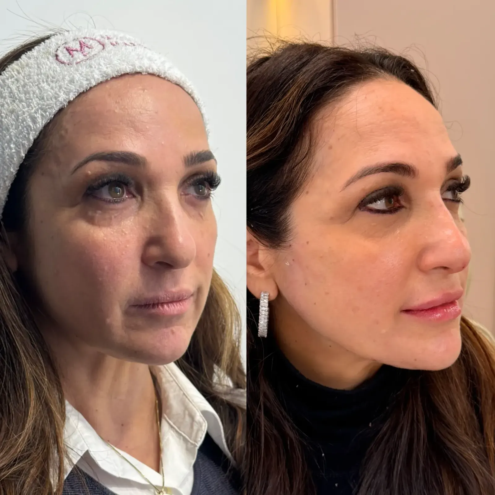 Caso 2 — Preenchimento Full Face