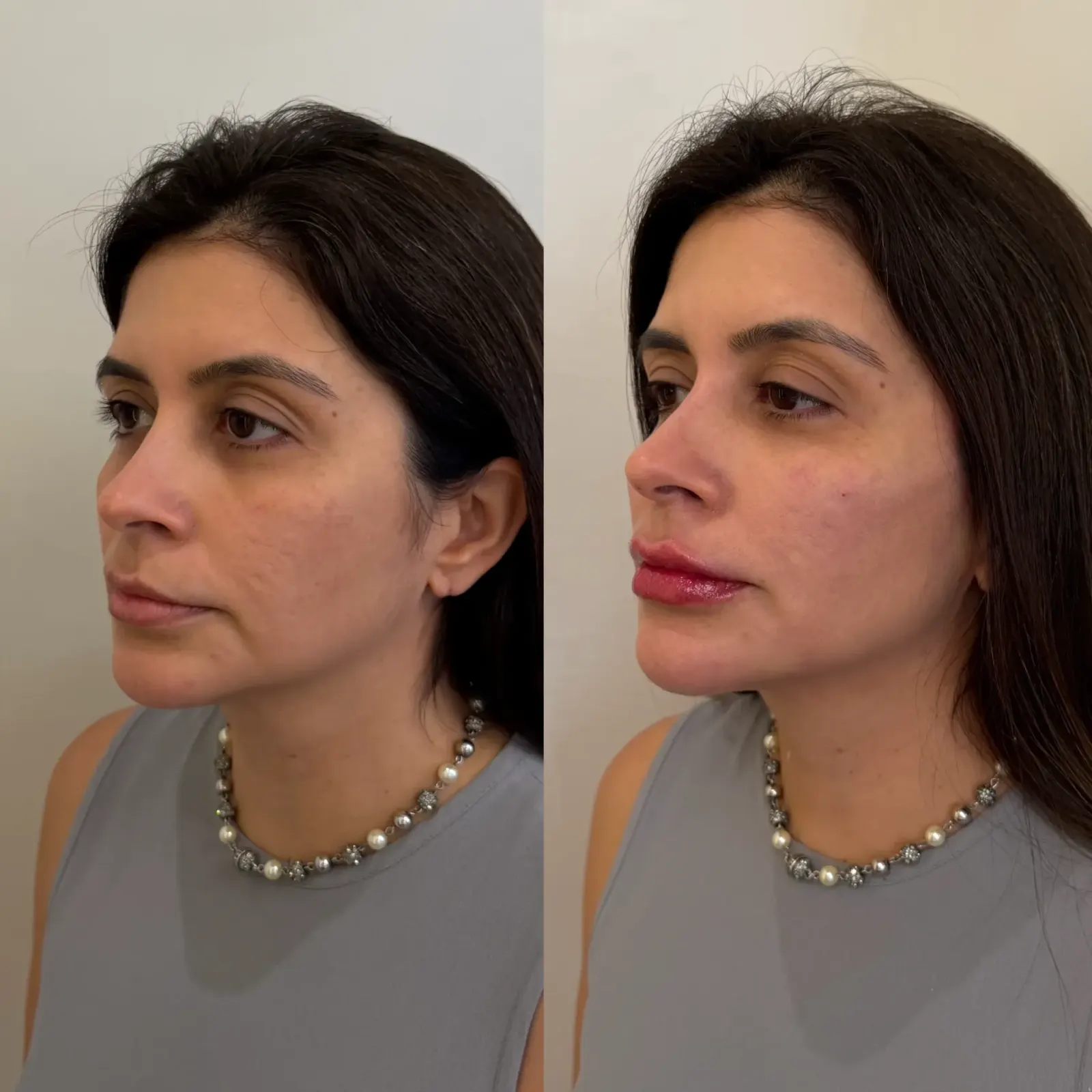 Caso 1 — Preenchimento Full Face