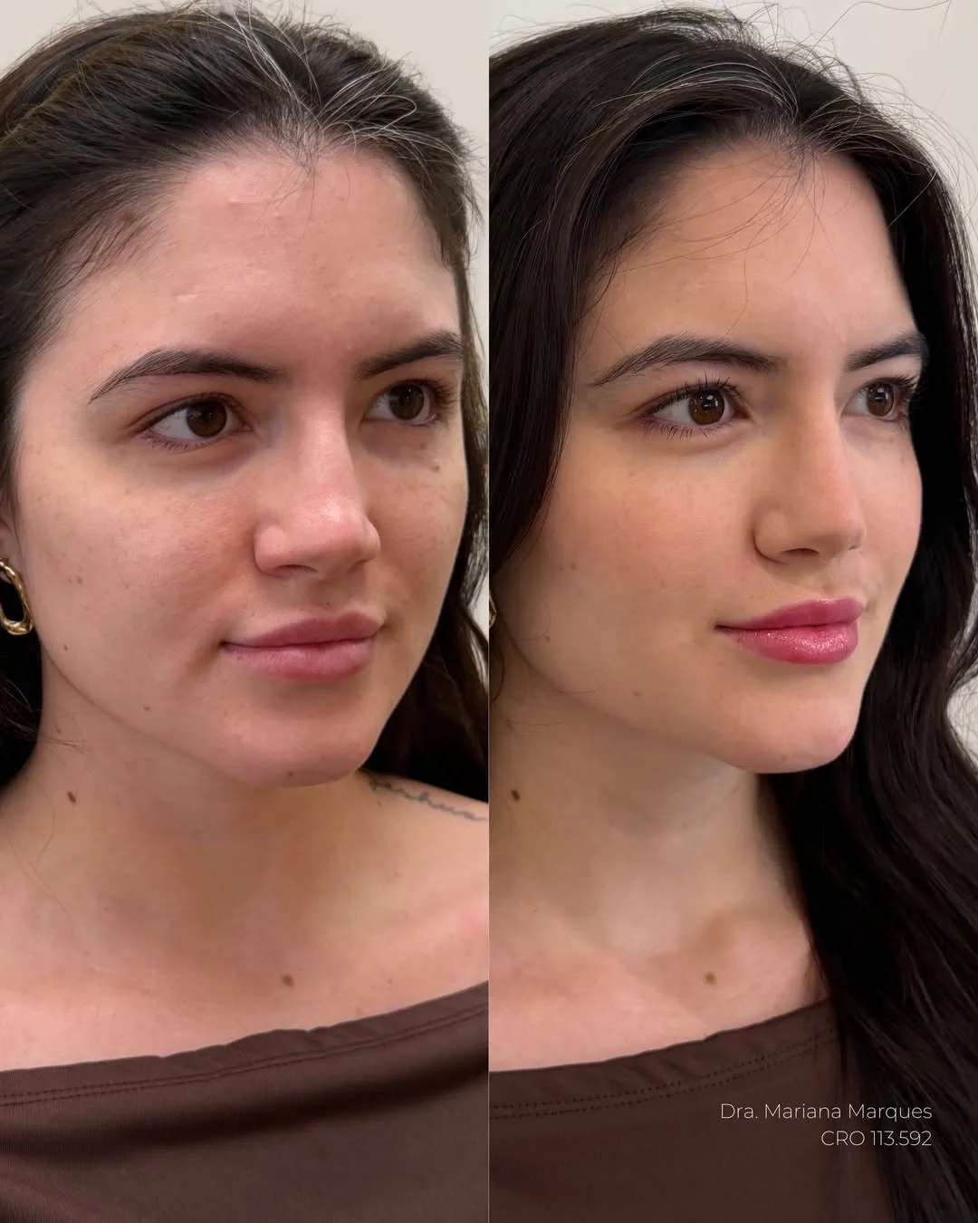 Caso 3 — Preenchimento Full Face